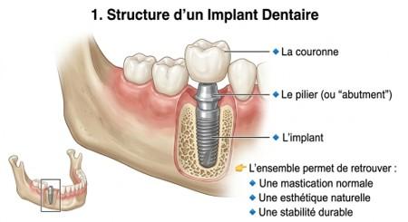 strucutre implant dentaire1